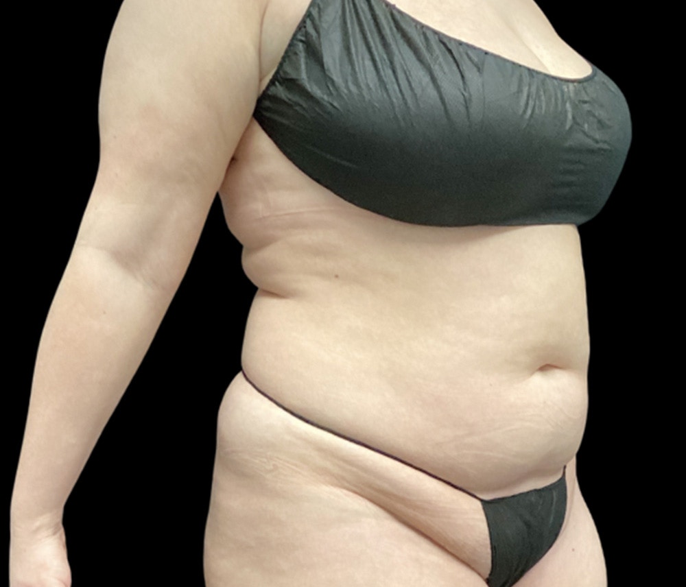 Liposuction Before & After Gallery - Patient 385572 - Image 3