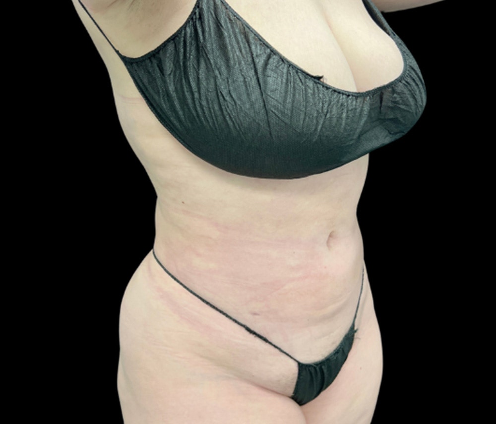 Liposuction Before & After Gallery - Patient 385572 - Image 4