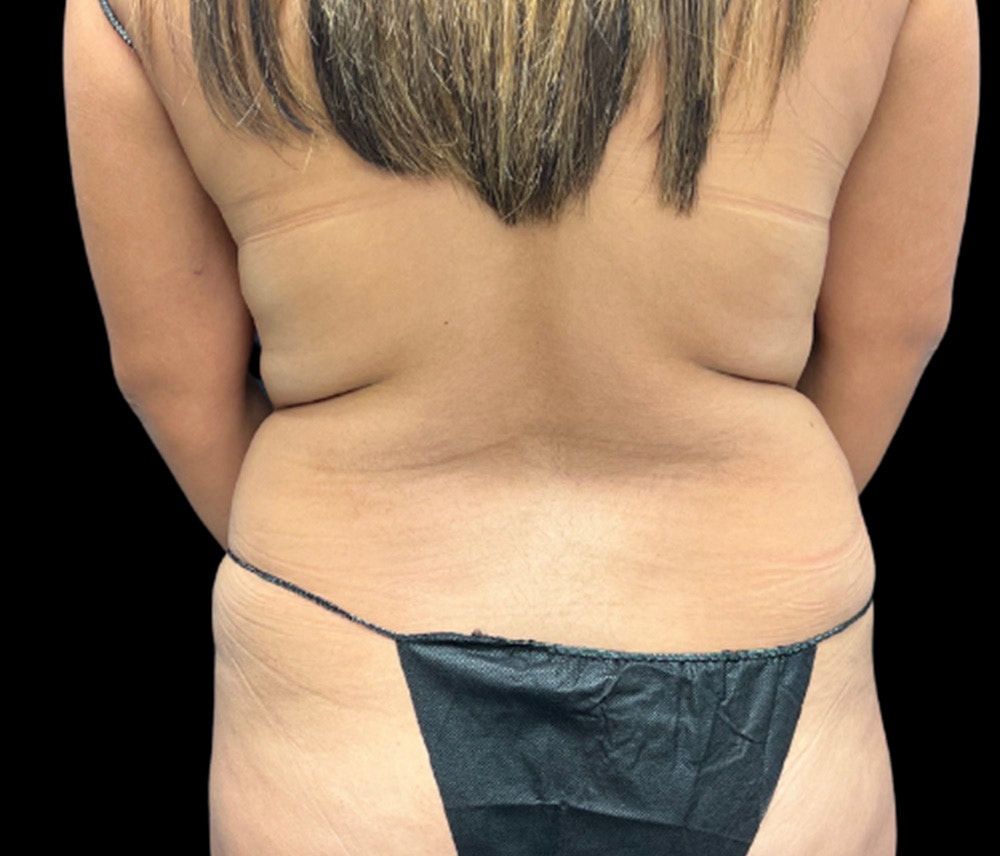 Liposuction Before & After Gallery - Patient 374356 - Image 7
