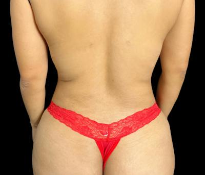 Liposuction Before & After Gallery - Patient 374356 - Image 8