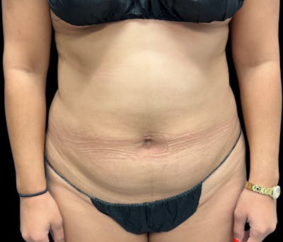 Liposuction Before & After Gallery - Patient 374356 - Image 1