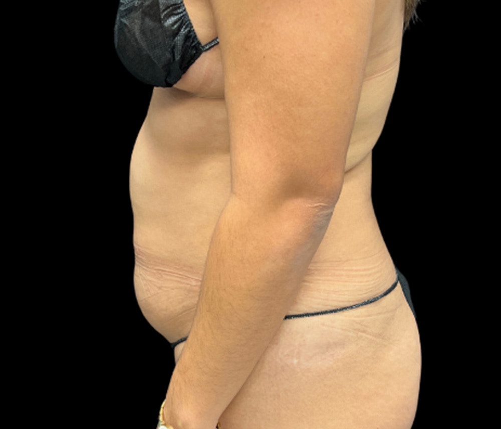 Liposuction Before & After Gallery - Patient 374356 - Image 5
