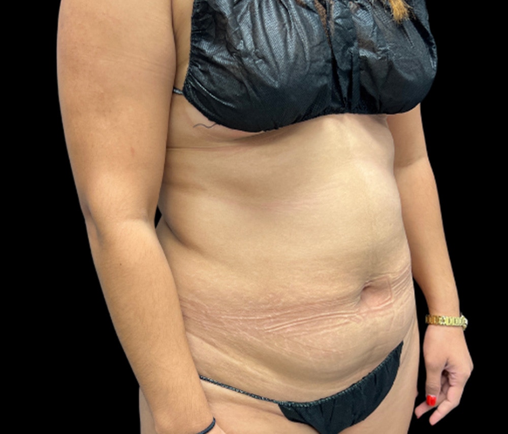 Liposuction Before & After Gallery - Patient 374356 - Image 3
