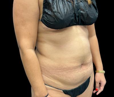 Liposuction Before & After Gallery - Patient 374356 - Image 3