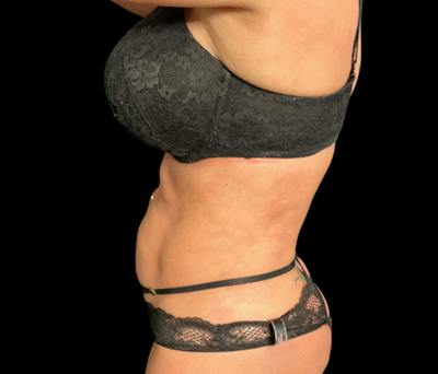 Liposuction Before & After Gallery - Patient 379298 - Image 8