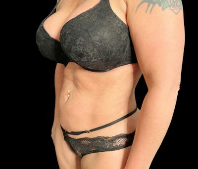 Liposuction Before & After Gallery - Patient 379298 - Image 6