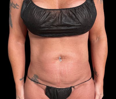Liposuction Before & After Gallery - Patient 379298 - Image 1