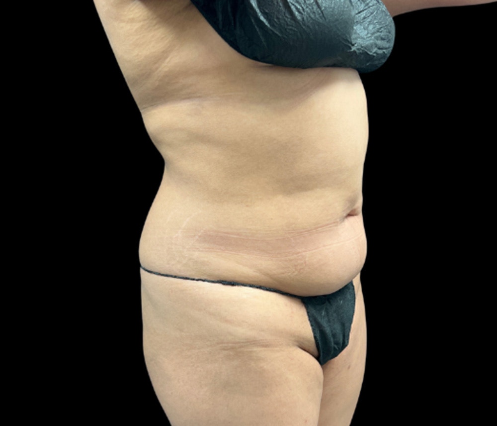 Liposuction Before & After Gallery - Patient 133775 - Image 3