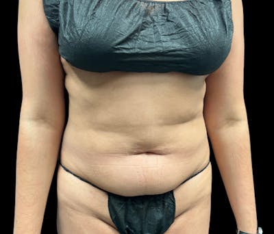 Liposuction Before & After Gallery - Patient 133775 - Image 1