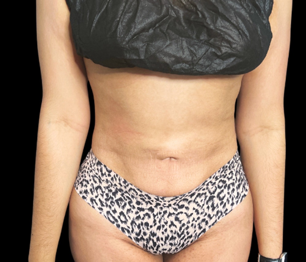 Liposuction Before & After Gallery - Patient 133775 - Image 2