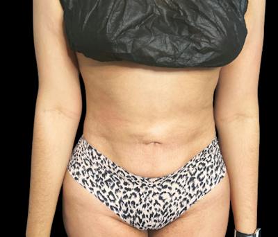 Liposuction Before & After Gallery - Patient 133775 - Image 2