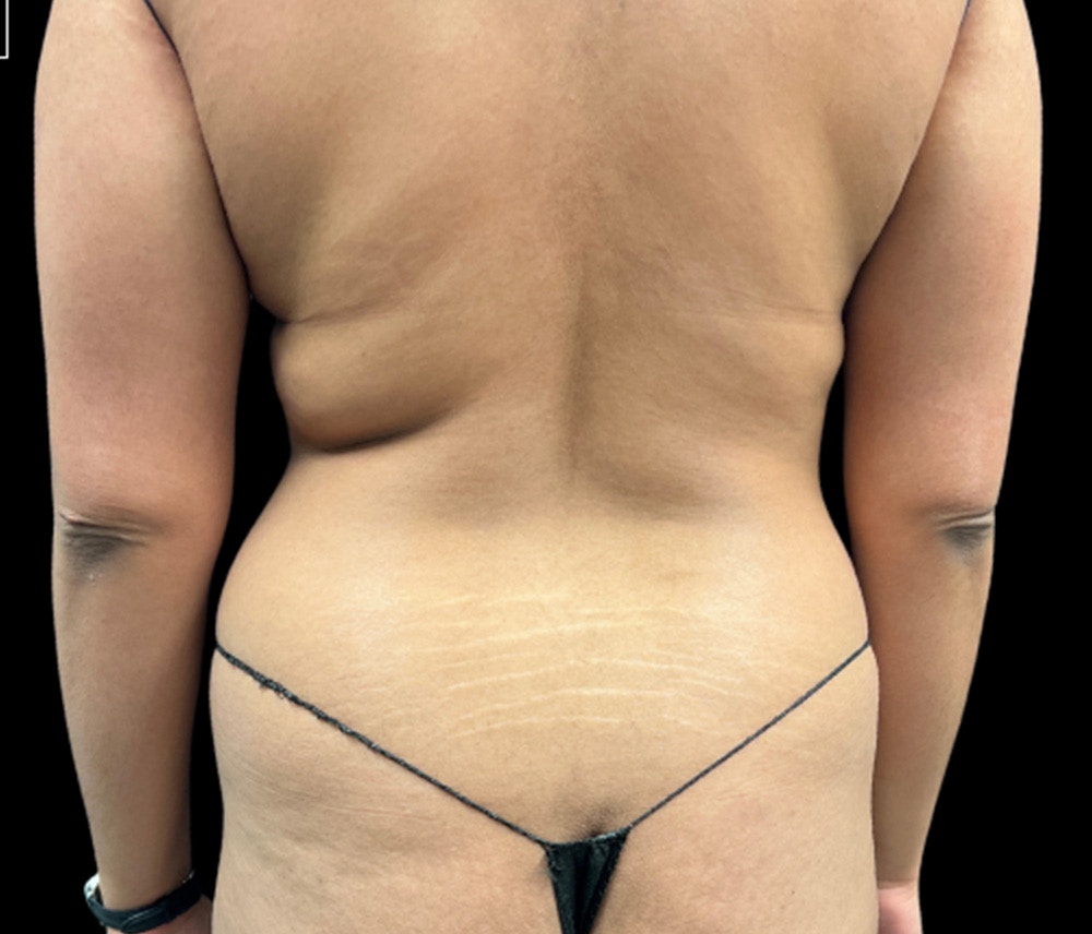 Liposuction Before & After Gallery - Patient 133775 - Image 5