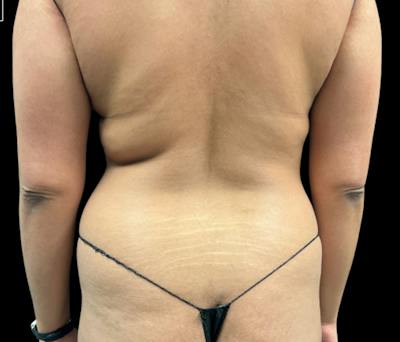 Liposuction Before & After Gallery - Patient 133775 - Image 5