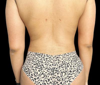 Liposuction Before & After Gallery - Patient 133775 - Image 6