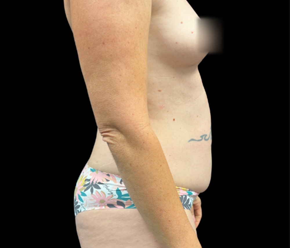 Liposuction Before & After Gallery - Patient 407092 - Image 3