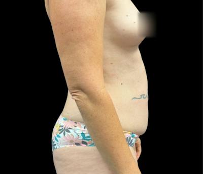 Liposuction Before & After Gallery - Patient 407092 - Image 3