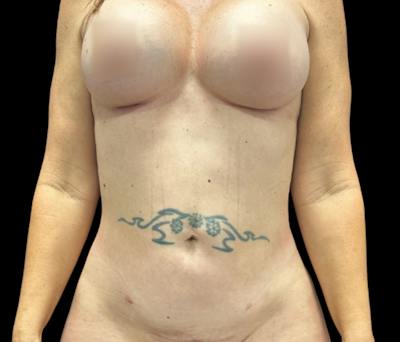 Liposuction Before & After Gallery - Patient 407092 - Image 2