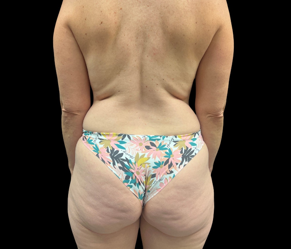 Liposuction Before & After Gallery - Patient 407092 - Image 5