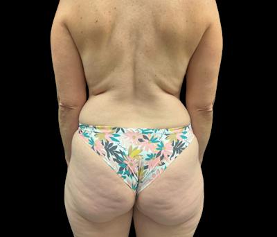 Liposuction Before & After Gallery - Patient 407092 - Image 5