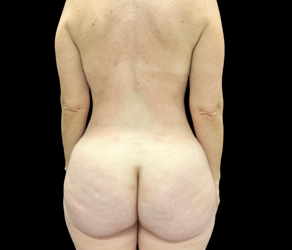 Liposuction Before & After Gallery - Patient 407092 - Image 6
