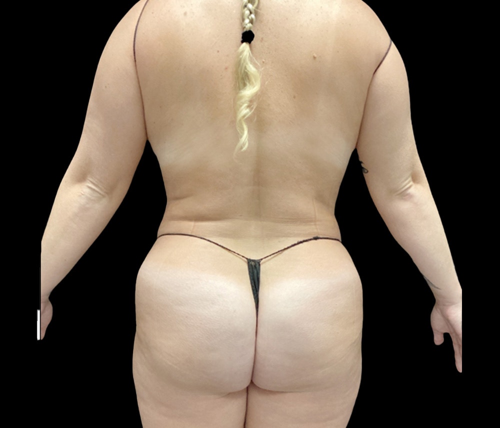 Liposuction Before & After Gallery - Patient 746746 - Image 6