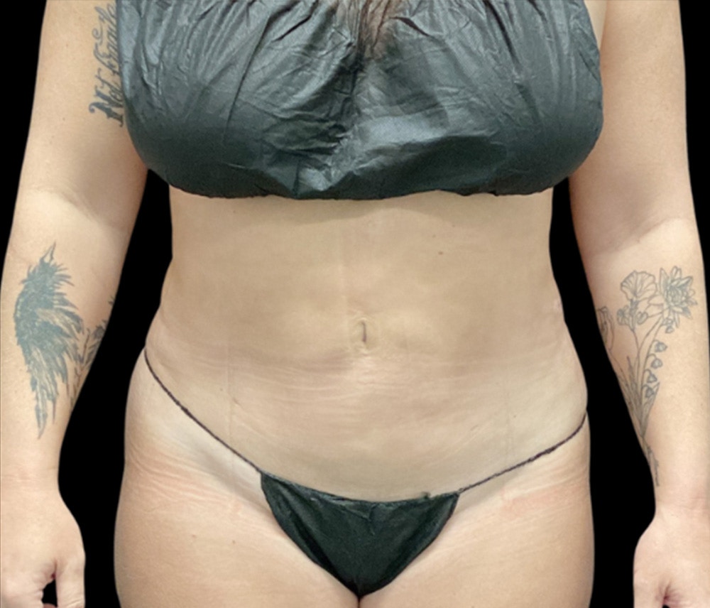 Liposuction Before & After Gallery - Patient 746746 - Image 2