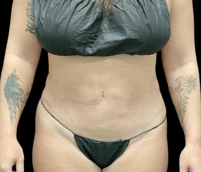 Liposuction Before & After Gallery - Patient 746746 - Image 2