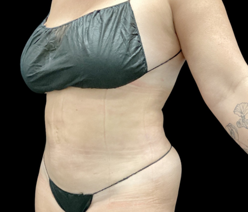 Liposuction Before & After Gallery - Patient 746746 - Image 4