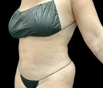 Liposuction Before & After Gallery - Patient 746746 - Image 4