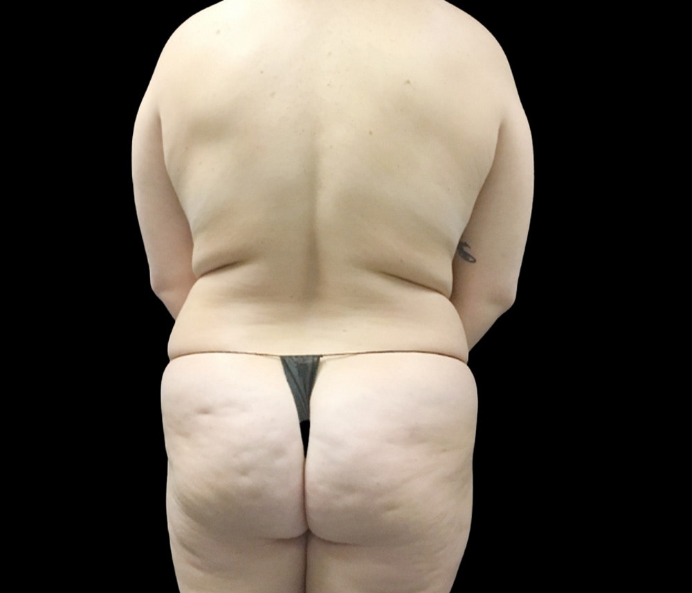 Liposuction Before & After Gallery - Patient 746746 - Image 5