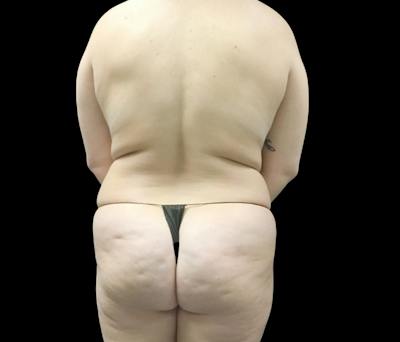 Liposuction Before & After Gallery - Patient 746746 - Image 5