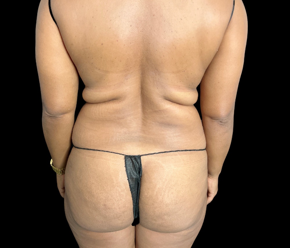 Liposuction Before & After Gallery - Patient 347537 - Image 5