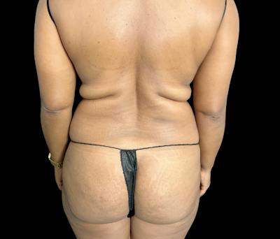 Liposuction Before & After Gallery - Patient 347537 - Image 5