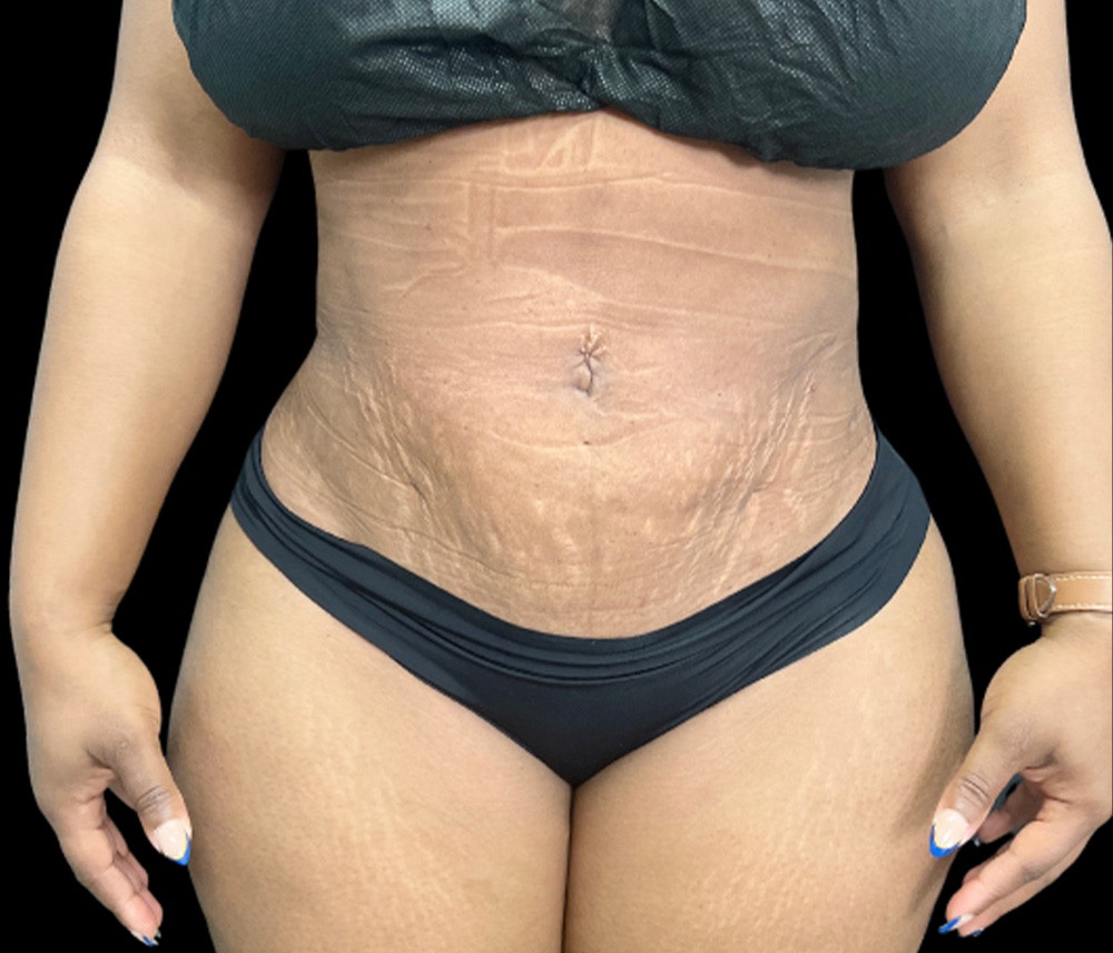 Liposuction Before & After Gallery - Patient 347537 - Image 2