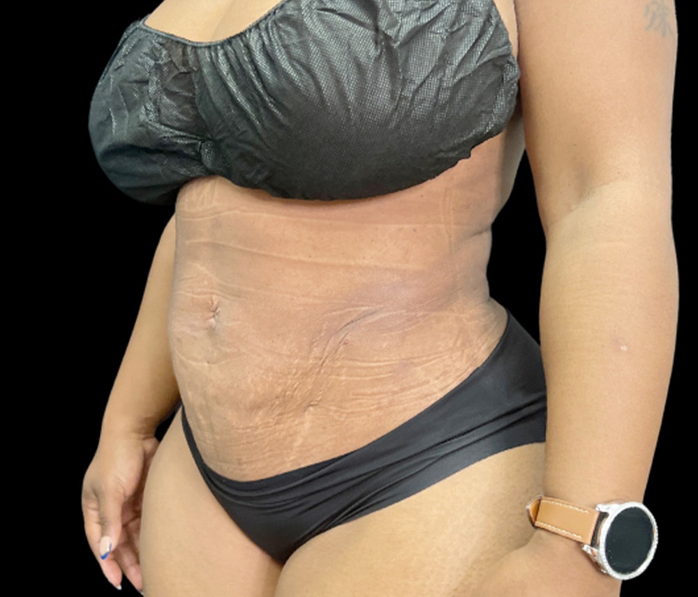 Liposuction Before & After Gallery - Patient 347537 - Image 4