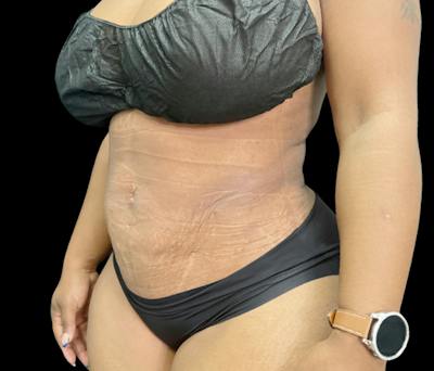 Liposuction Before & After Gallery - Patient 347537 - Image 4