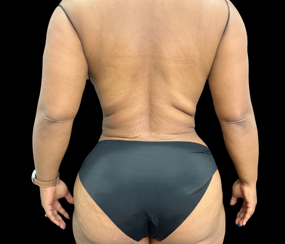 Liposuction Before & After Gallery - Patient 347537 - Image 6