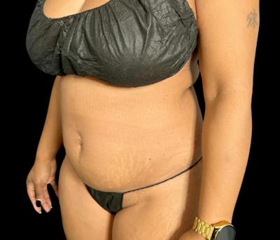 Liposuction Before & After Gallery - Patient 347537 - Image 3
