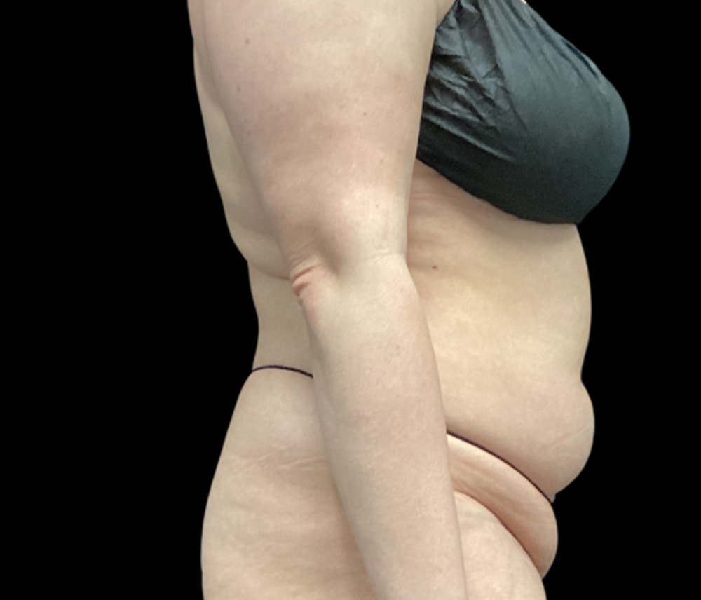 Liposuction Before & After Gallery - Patient 125012 - Image 3
