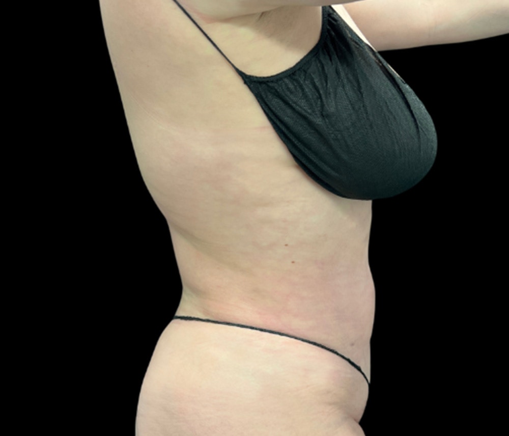 Liposuction Before & After Gallery - Patient 125012 - Image 4