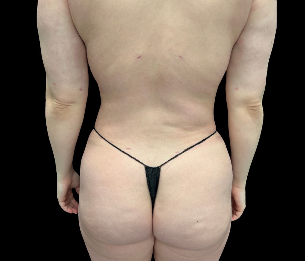 Liposuction Before & After Gallery - Patient 125012 - Image 6