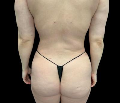 Liposuction Before & After Gallery - Patient 125012 - Image 6