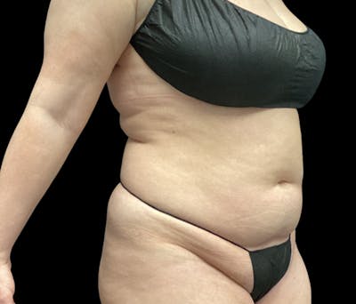 Liposuction Before & After Gallery - Patient 125012 - Image 1