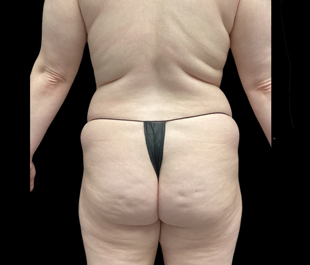 Liposuction Before & After Gallery - Patient 125012 - Image 5