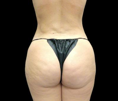 Liposuction Before & After Gallery - Patient 401274 - Image 3