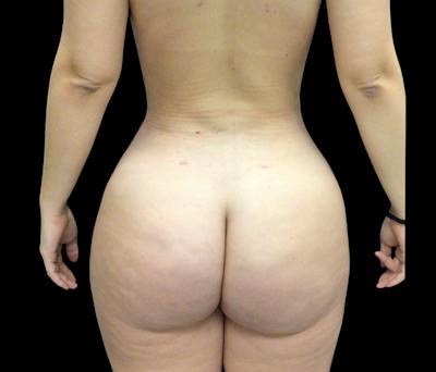 Liposuction Before & After Gallery - Patient 401274 - Image 4