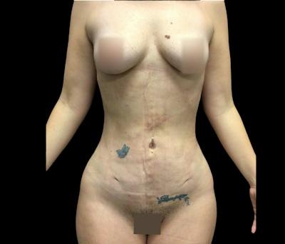 Liposuction Before & After Gallery - Patient 401274 - Image 2