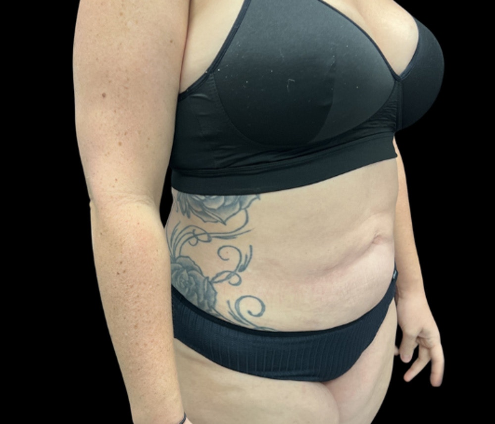 Liposuction Before & After Gallery - Patient 258816 - Image 4