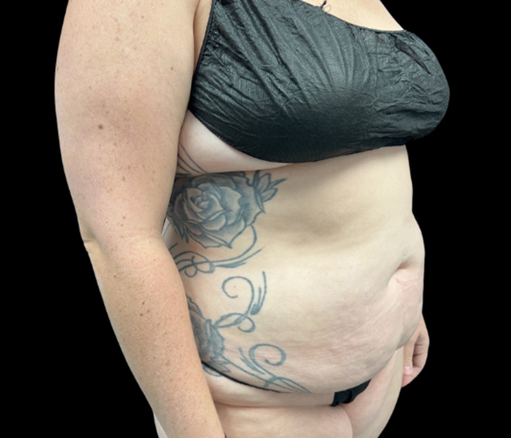 Liposuction Before & After Gallery - Patient 258816 - Image 3