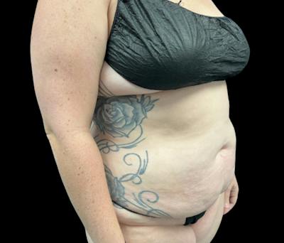 Liposuction Before & After Gallery - Patient 258816 - Image 3